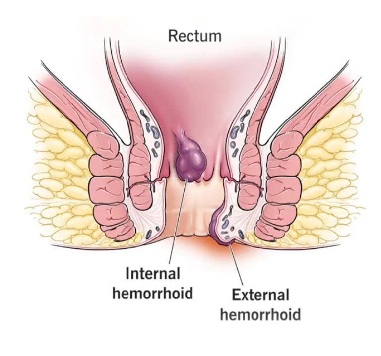 Hemorrhoid care visual 1